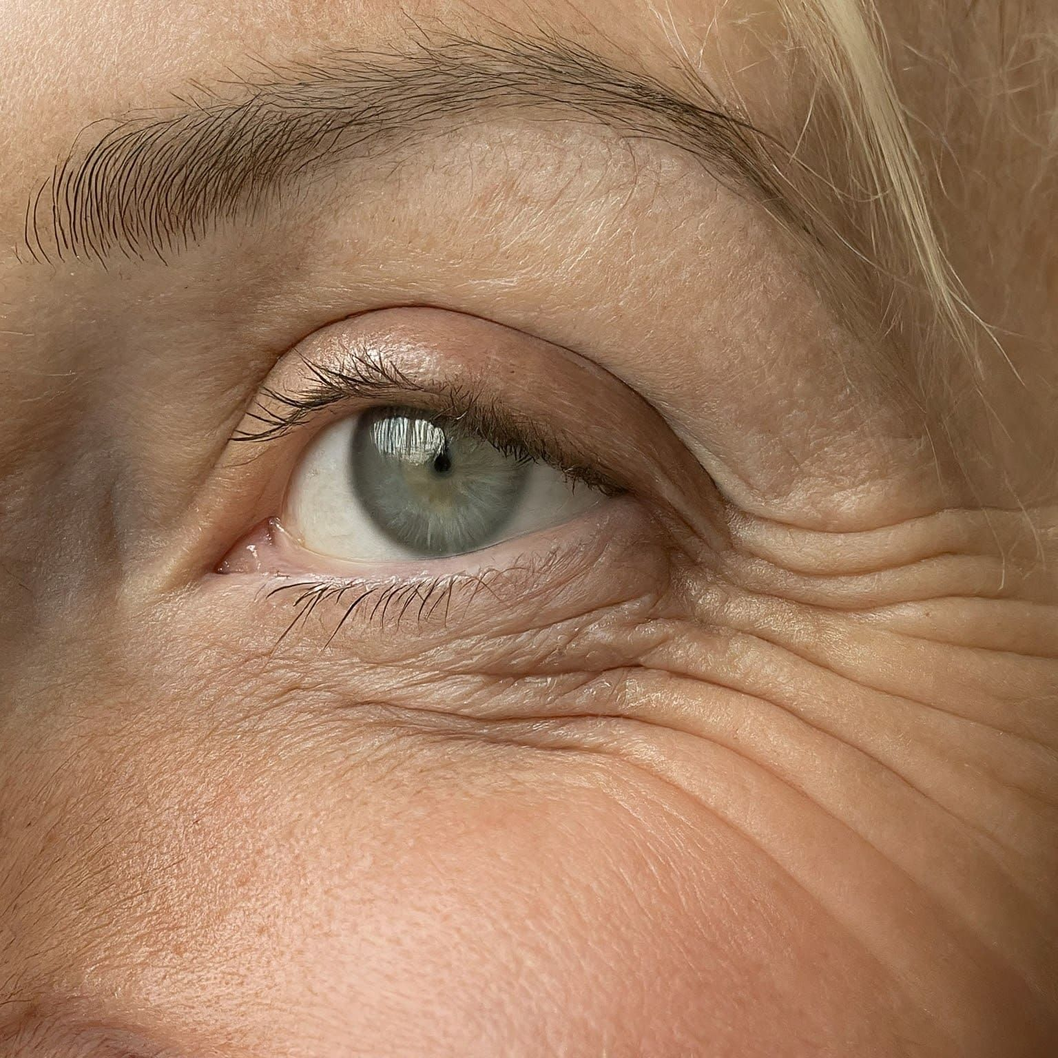 Botox Treatment at GH Derma Center